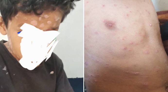 كارثة غير مسبوقة... أوبئة صامتة تجتاح صنعاء ومناطق ميليشيا الحوثي 