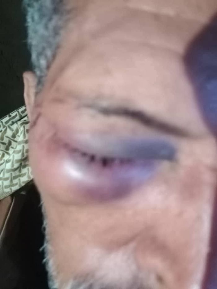 تعز.. مرافق مدير الشمايتين وشقيقه يعتديان على مواطن بالسوق ويصيّبانه بجروح خطيرة